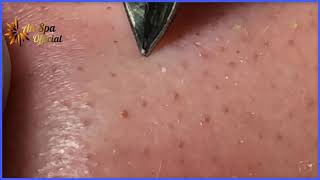 Best Satisfying Nose Plucking Blackheads Whiteheads Removal  Acne Treatment 37 [upl. by Lanie]