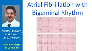 Atrial Fibrillation with Bigeminal Rhythm [upl. by Rolat]