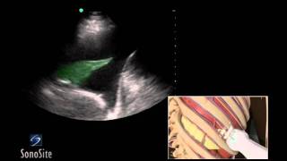 How To Ultrasound Guided Thoracentesis Exam 3D Video [upl. by Anoiuq121]