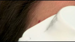 Safe Effective Laser Treatment for Angiomas with LightPod Neo by David J Goldberg [upl. by Akinahc]