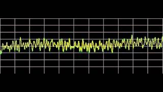 Rheumatoid Arthritis  Rife Frequencies [upl. by Hutt]