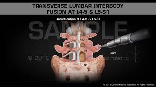 Transverse Lumbar Interbody Fusion at L45 amp L5S1  Medical Animation [upl. by Oah306]