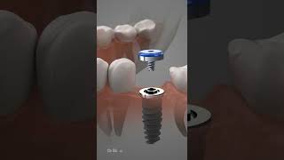 Dental Implant Procedure [upl. by Mohammed886]