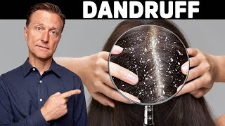 The REAL Cause and Cure for DANDRUFF [upl. by Kelcey864]