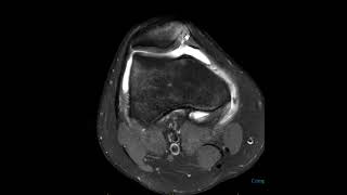 Transient patellar dislocation with displaced chondral fragment [upl. by Cassella466]