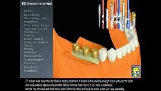 MegaGen  3D EZ Plus Internal [upl. by Zeugirdor]