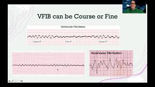 EKGVentricular Dysrhythmias [upl. by Samy565]