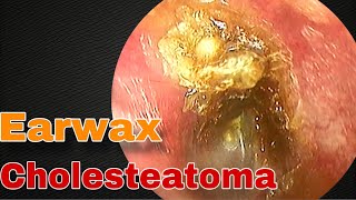 Earwax Sticks Lightly in Cholesteatoma Disease  Doctor Anh [upl. by Cai5]