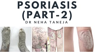 Psoriasis  Types Symptoms and Diagnosis Part  2 [upl. by Ellenahc]