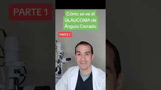 Cómo se ve el GLAUCOMA de Ángulo Cerrado oftalmologia glaucoma ojo cornea cirugia miopia [upl. by Canute]