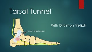 Tarsal Tunnel Syndrome [upl. by Lindgren]