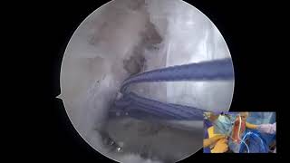 Posterior Lateral Meniscal Root Repair Through Lateral Tunnel and Anterior Cruciate Ligament Revisio [upl. by Kast]