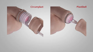 A comparison of Circumplast® and Plastibell® Circumcision Devices [upl. by Marder]