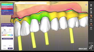 DESIGN FULL ARCH END GINGIVA MULTIUNITE BRIDGExocadExoplan3ShapeInLabCerecSUM3DIcamv5 [upl. by Eibloc89]