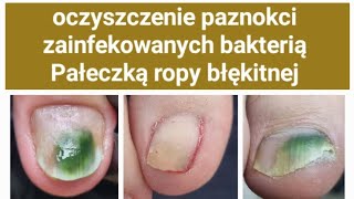 bakteria na paznokciach  Pałeczka ropy błękitnej PSUDOMONAS AERUGINOSA podopogotowie podologia [upl. by Annaeed]