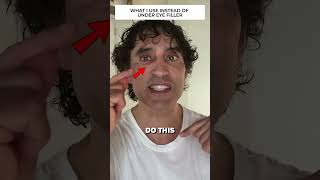 DISSOLVING MY UNDER EYE FILLER REACTION [upl. by Imnubulo]