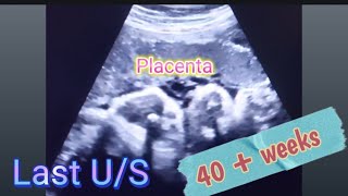 Baby BOY placenta position gender prediction  Anterior Placenta baby gender  how to reveal gender [upl. by Adella477]