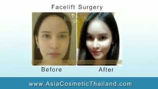 Before amp After Facelift in Bangkok Thailand  DrTanongsak [upl. by Farlie645]