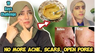 10 Days Challenge  No More ACNE Pimples amp Dark Spots  Get FAIR Poreless Flawless Skin [upl. by Lledal]