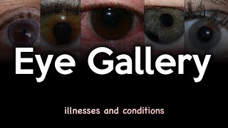 Eye Illnesses and Conditions Image Gallery [upl. by Hennahane]