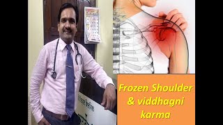 Frozen shoulder  अवबाहुक  viddhagni karma  single sitting  75 results with golden steak [upl. by Enerol171]