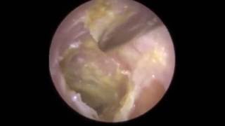 Infection of Eardrum visible after Hard Ear Wax Removal  Mr Neel Raithatha The Hear Clinic [upl. by Lleinad874]