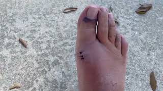 3  8 Days PostSurgery  Cheilectomy Surgery  Patient Recovery amp Review Hallux Rigidus Big Toe [upl. by Cesaro]