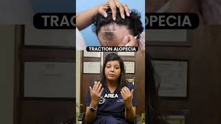 Traction Alopecia  Hair Transplant Clinic  Dadu Medical Centre [upl. by Harmony]