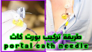 تركيب ابرة القسطرة الوريدية البورت كاث port a cath [upl. by Ojimmas375]