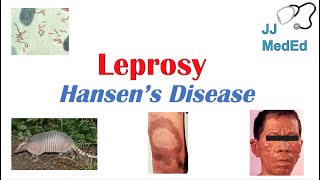 Leprosy Hansens disease  Who is at risk Signs and Symptoms Diagnosis and Treatment [upl. by Hortensia]