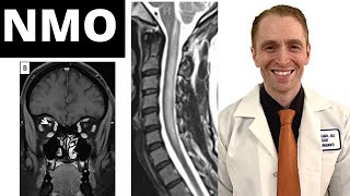 Neuromyelitis Optica NMO Symptoms Diagnosis MRI Findings Treatment Clinical Trial Results [upl. by Lekim]