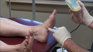 Painful Plantar Fibromas in Feet [upl. by Gilder]