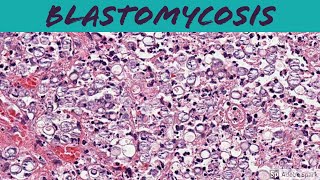 Blastomycosis 5Minute Pathology Pearls [upl. by Ennovyhc]