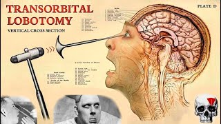 The TERRIFIC History of Lobotomy [upl. by Leahcimsemaj624]