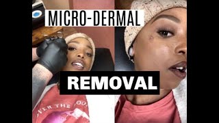 MicroDermal Piercing Removal  Piercing Update [upl. by Wallis647]