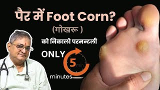 Corn callosities Hindiपैर में Foot Corn यानी गोखरू होना आम बात है इससे कैसे बचेंFoot Corn Disease [upl. by Yeniffit]