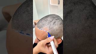 Restoring the hairline and filling temples for early stage hair loss vincihairclinic shorts [upl. by Airetnohs800]