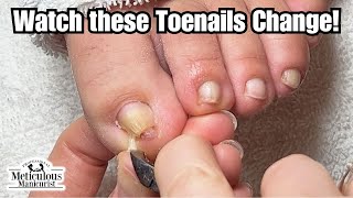 Pinched Yellow Toenail Change with Pedicure [upl. by Elleira]