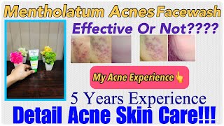 Mentholatum Acnes Facewash  My 5 Years Experience Review  Detail Acne Care Must Watch Before buy [upl. by Gregrory]