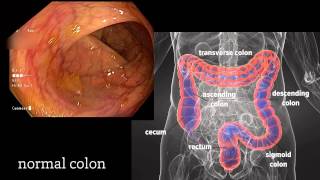 Colonoscopy A Journey Though the Colon and Removal of Polyps [upl. by Brainard]