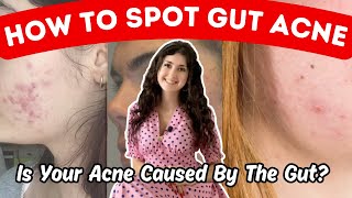 6 Gut Acne Signs amp Symptoms The Gut Acne Connection amp How To Heal Your Gut Acne [upl. by Anaer]