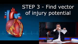 Step by step Vectorial analysis of Myocardial Infarction in ECG [upl. by Anahc583]