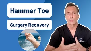 How Long Is Recovery From Hammer Toe Surgery [upl. by Wootten]