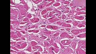 Histopathology Heart Amyloidosis [upl. by Amaty427]