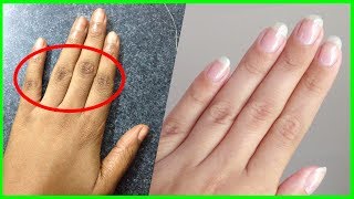 Home Remedies To Lighten Dark Fingers  Knuckles Whitening [upl. by Suoinuj]