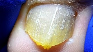 Onychomycosis trimming treatment to remove bad nails【Xue Yidao Pedicure】 [upl. by Los556]