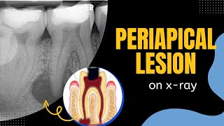 Periapical lesions Periapical Radiolucency Oral Pathology Bone Inflammatory Lesions [upl. by Magill133]