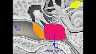 GLOMUS and its D D [upl. by Garber]