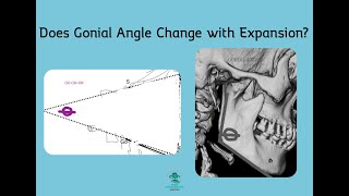 What is the difference between Gonial Angle and Mandibular Plane Angle Cephalometric Xray [upl. by Arod]