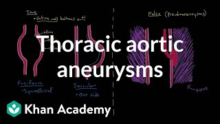 Thoracic aortic aneurysms  Circulatory System and Disease  NCLEXRN  Khan Academy [upl. by Churchill]